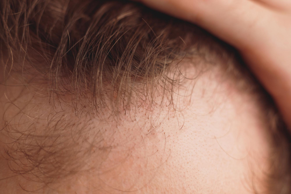 Mesotherapy Hair Transplant