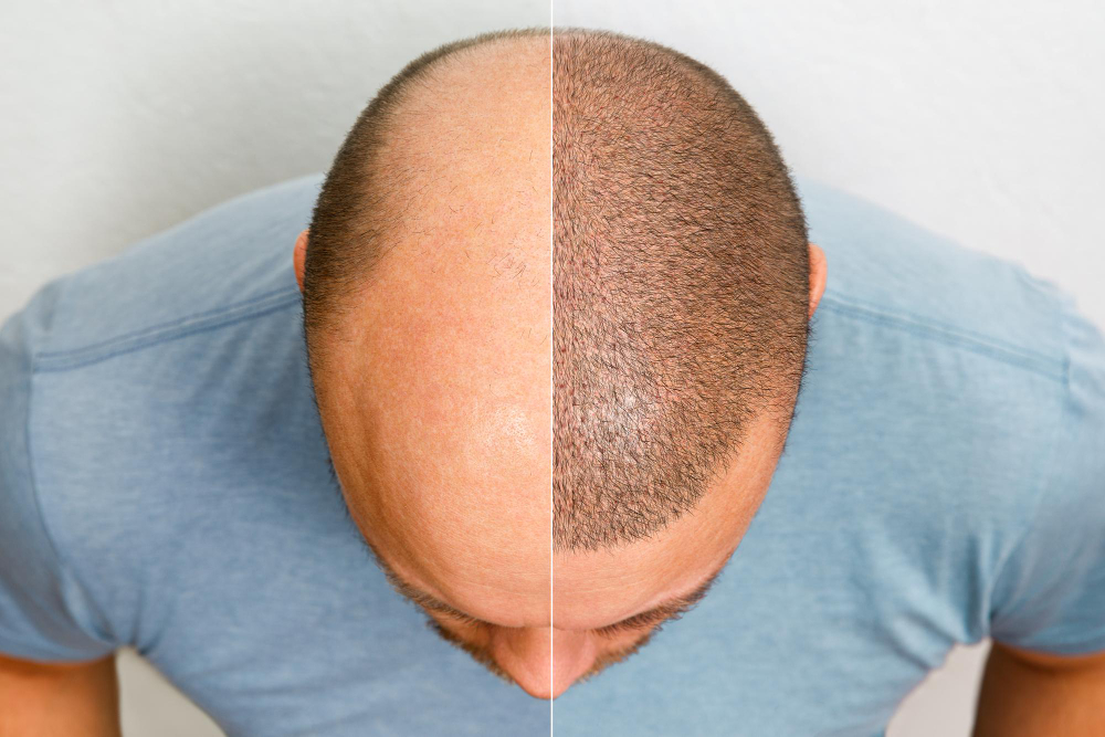 Before & After Hair Transplant